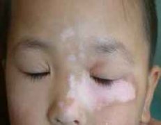 白癜风病因